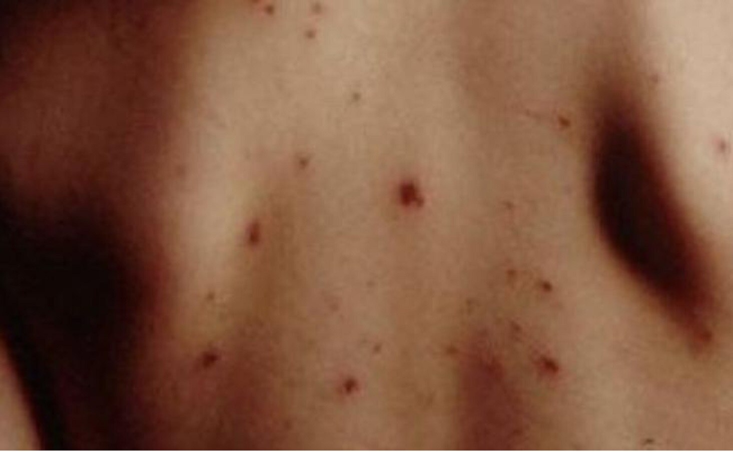 El sector salud federal reconoció que los casos reportados representan un aumento del 23% en relación al 2017. Foto: Cuauhtémoc Moreno Cabrera