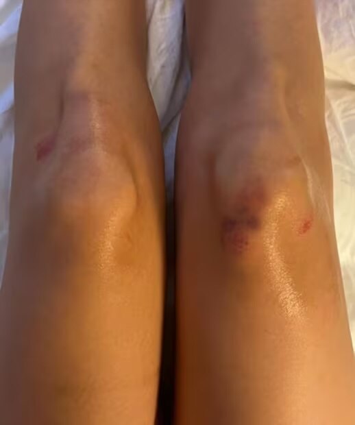 La cantante compartió las marcas que le dejó su aparatosa caída. Foto: Instagram.