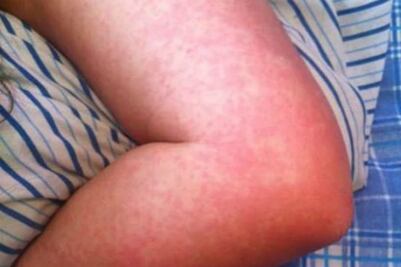 Reportan 3 casos de chikungunya en la entidad