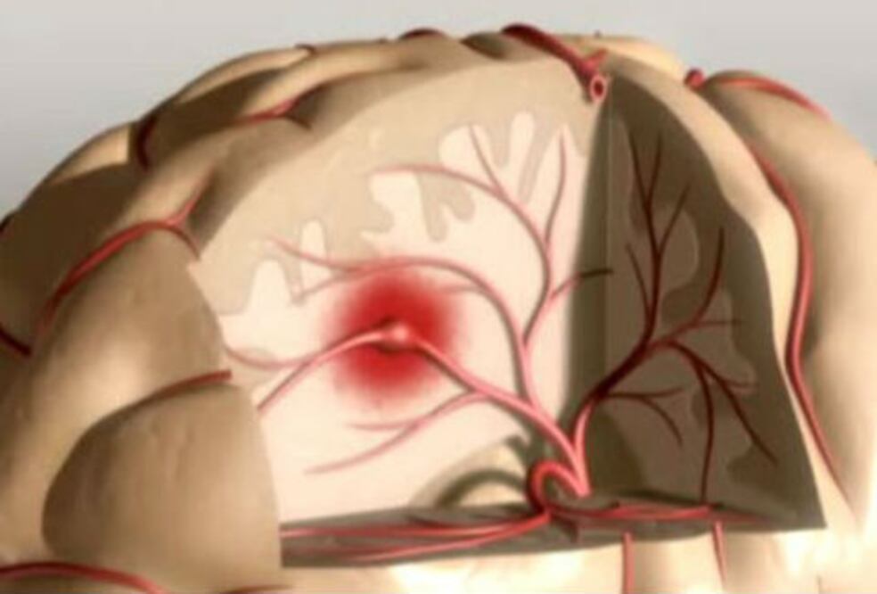 Alerta SESEQ sobre EVC