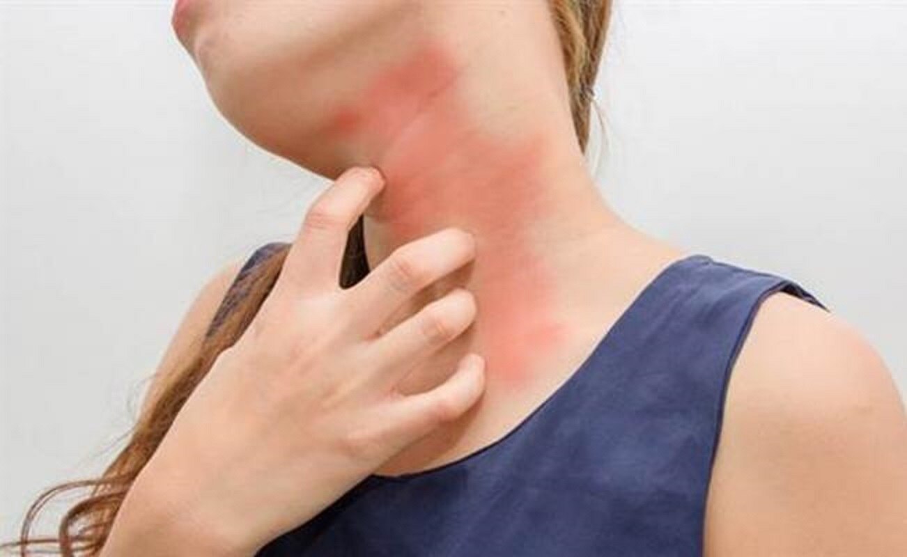 El 20% de la población en México padece alguna alergia