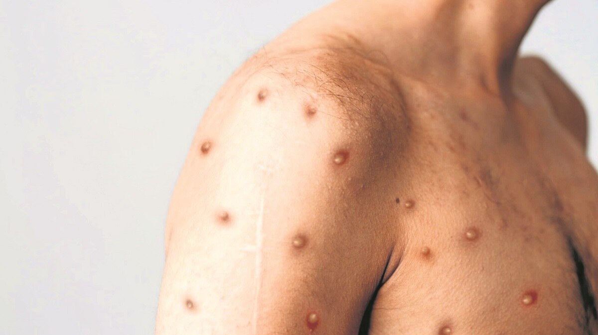 Se da en el estado el caso 1 de viruela símica