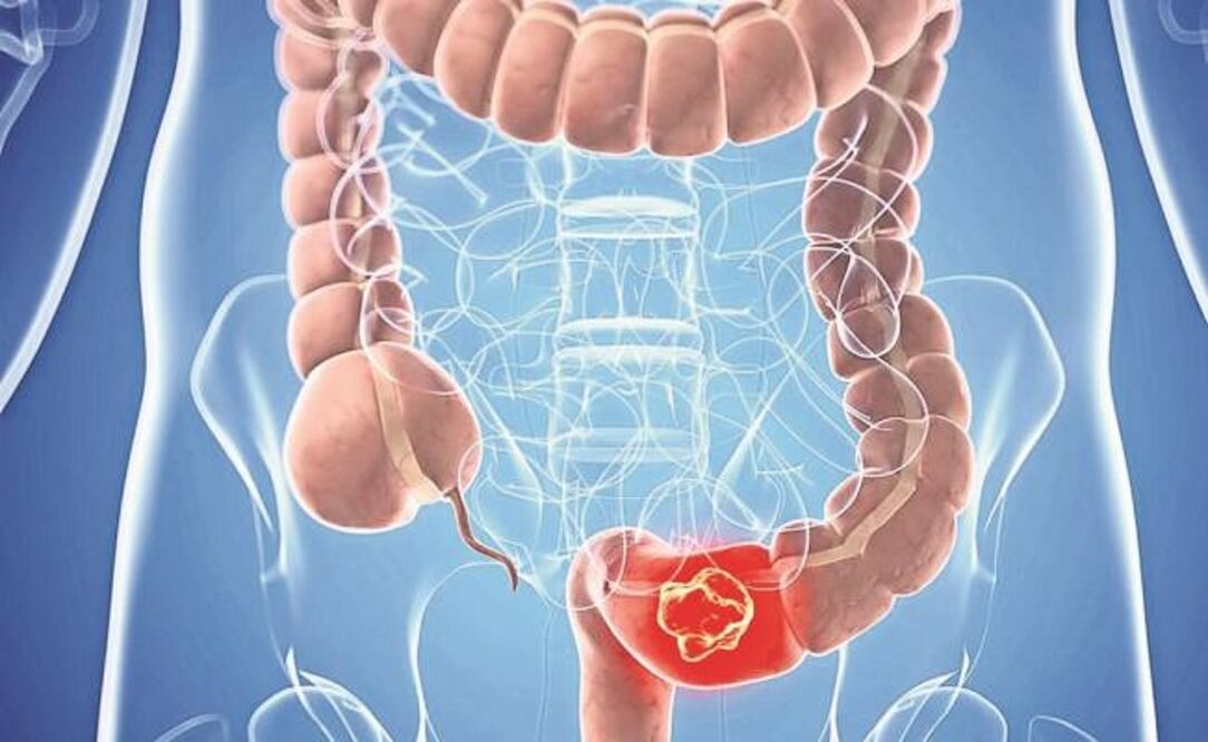 En 2015, este tipo de cáncer le quitó la vida a 774 mil personas en todo el mundo. (ESPECIAL