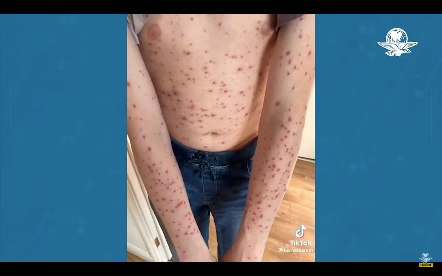 Viruela del mono no tarda en ser declarada pandemia, advierte experto de la OMS