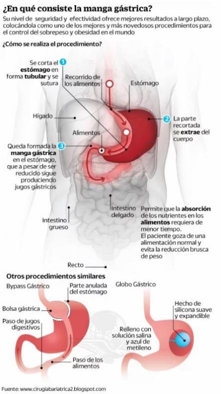 Cirugía gástrica: reducción de estómago en una hora, pero no es milagrosa