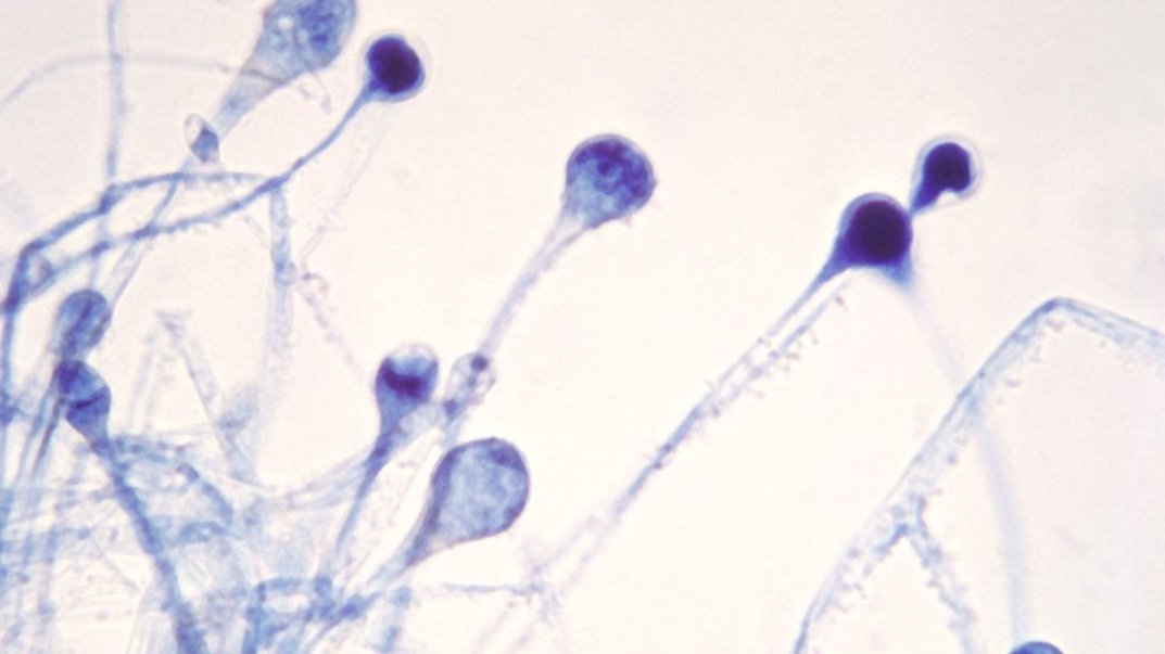 "Un desafío mayor que el coronavirus": India lucha contra casi 9 mil casos de mucormicosis
