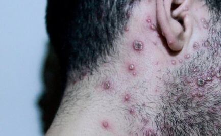 OMS: van más de 50 mil casos de viruela del mono en todo el mundo