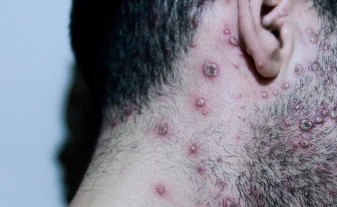 OMS: van más de 50 mil casos de viruela del mono en todo el mundo