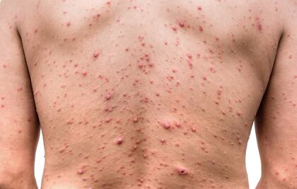 Confirman casos positivos de viruela símica en Querétaro