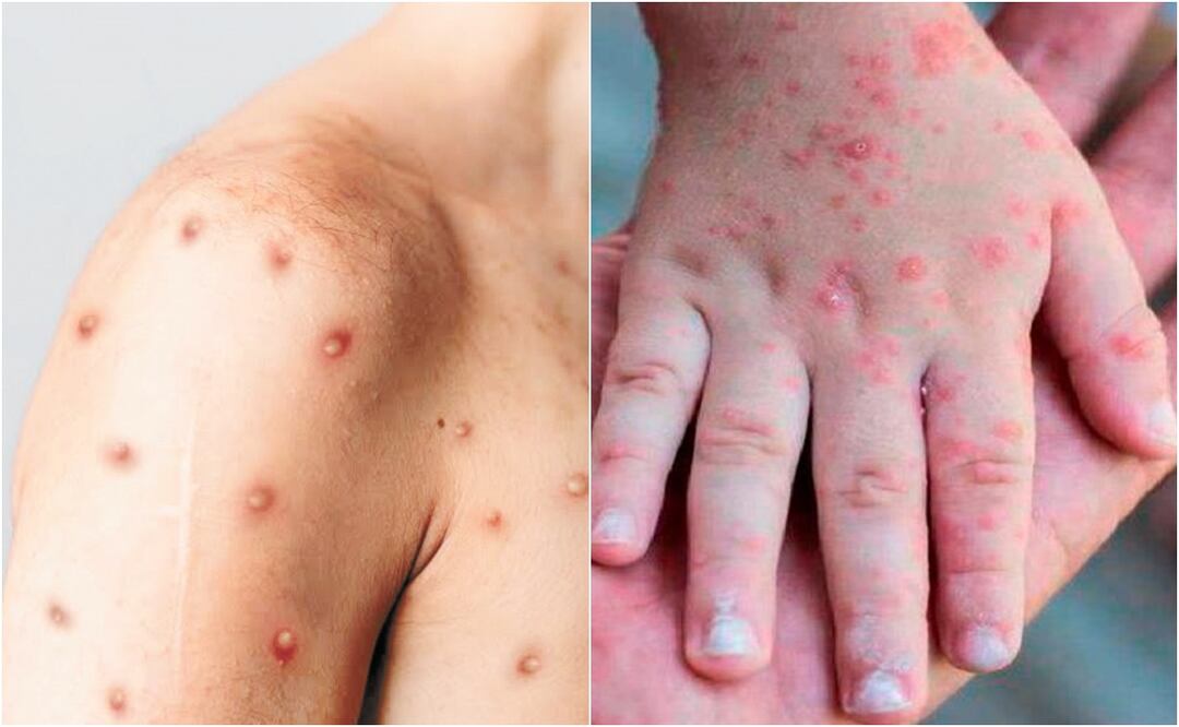 España confirma la segunda muerte por viruela del mono