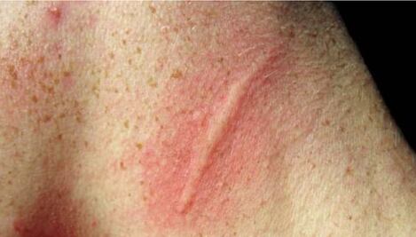 Hombre sufrió disfunción eréctil después de un arañazo de su gato