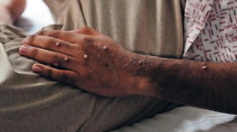 Capital de Querétaro concentra 83.3% de los casos de viruela