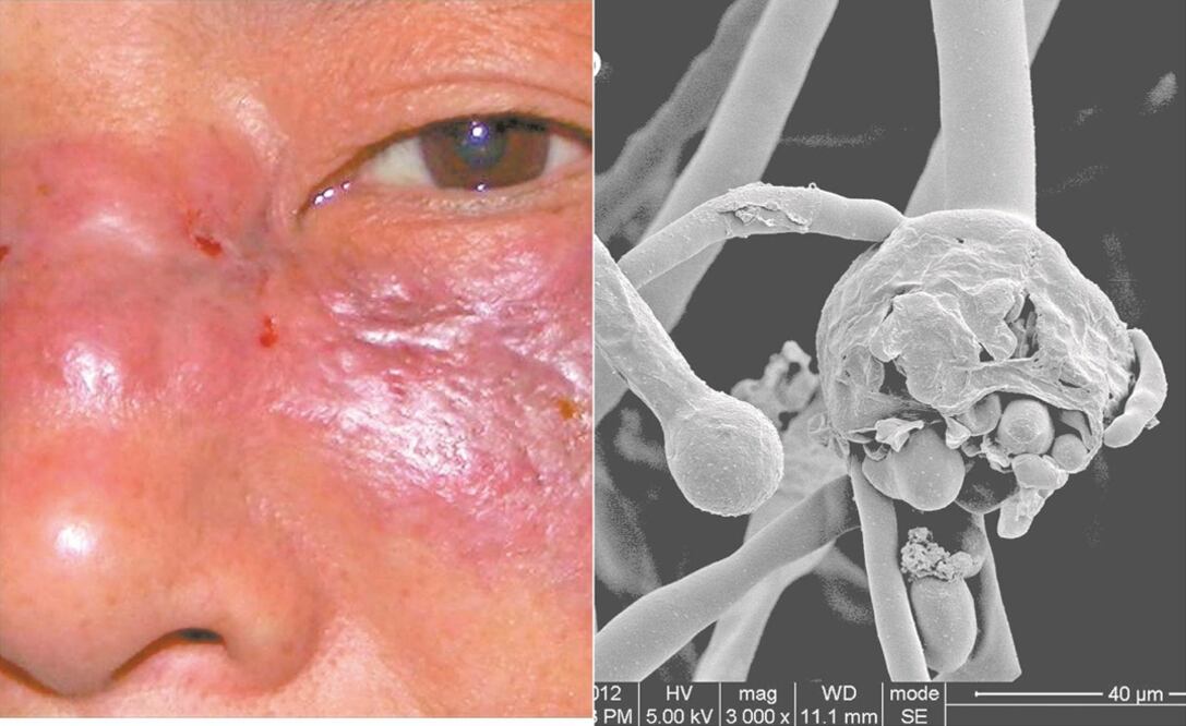 Reportan tercer caso sospechoso de Hongo Negro por Covid-19 en Oaxaca; ahora en la Cuenca