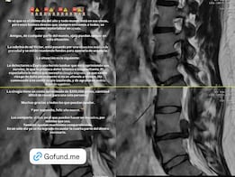 Solicitan apoyo para reunir fondos destinados a una cirugía urgente de Zayra, joven con hernia lumbar