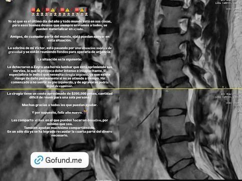 Solicitan apoyo para reunir fondos destinados a una cirugía urgente de Zayra, joven con hernia lumbar
