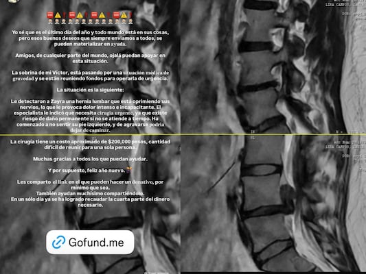 Solicitan apoyo para reunir fondos destinados a una cirugía urgente de Zayra, joven con hernia lumbar