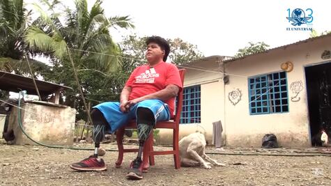 Perdió sus piernas por el huachicol; “no vale la pena arriesgarse”