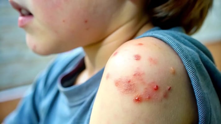 Van 46 contagios de sarampión en Querétaro