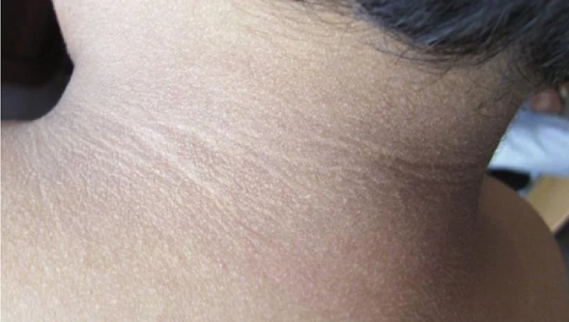 Oscurecimiento de cuello, signo de prediabetes