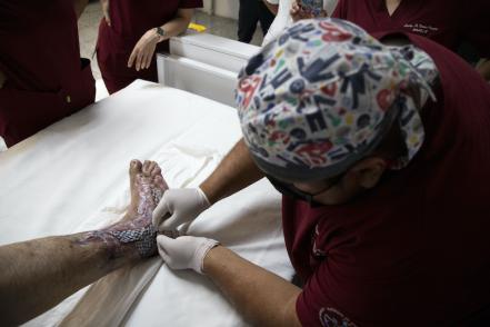 Injertan piel de pescado a pie diabético en la Universidad Autónoma de Querétaro