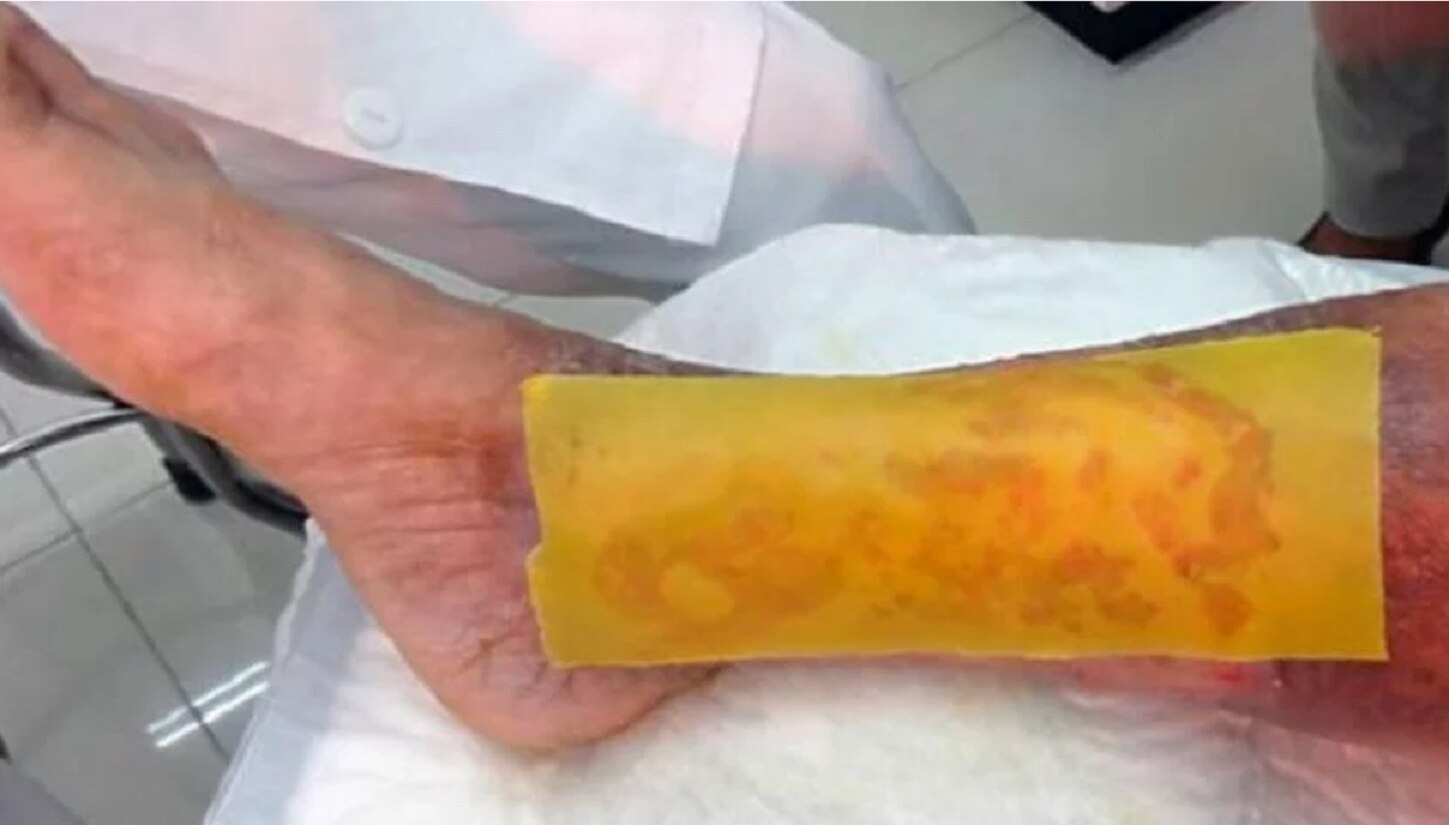 Crean parche hecho de miel que cicatriza heridas de pie diabético