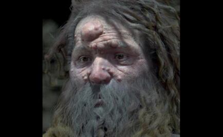 El hombre de Cromañón tenía la cara cubierta de nódulos