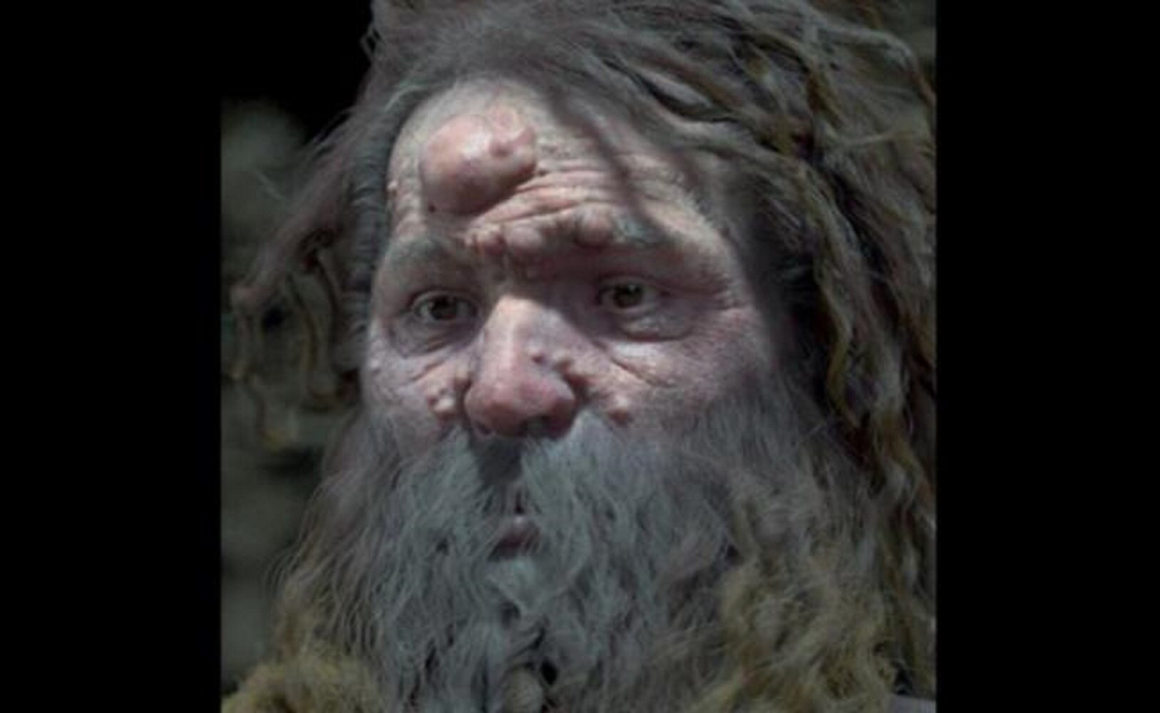 El hombre de Cromañón tenía la cara cubierta de nódulos