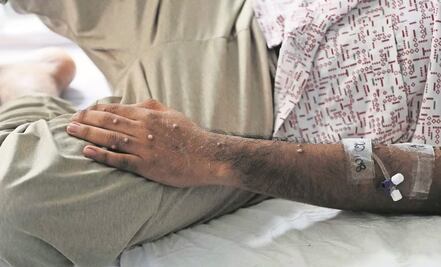 Brote de mpox, antes viruela del mono, en África incluye diferentes variantes y modos de transmisión: OMS