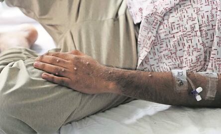 Brote de mpox, antes viruela del mono, en África incluye diferentes variantes y modos de transmisión: OMS