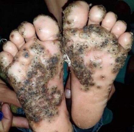 Niña contrae infección de pulgas por caminar descalza