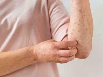 Autoridades locales descartan contagios de viruela del mono en Querétaro