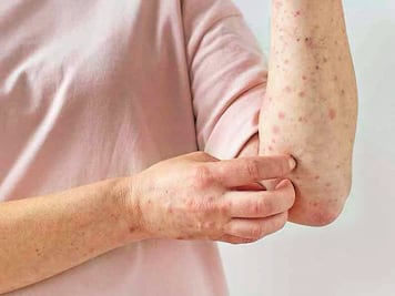 Querétaro registra el segundo caso importado de viruela símica