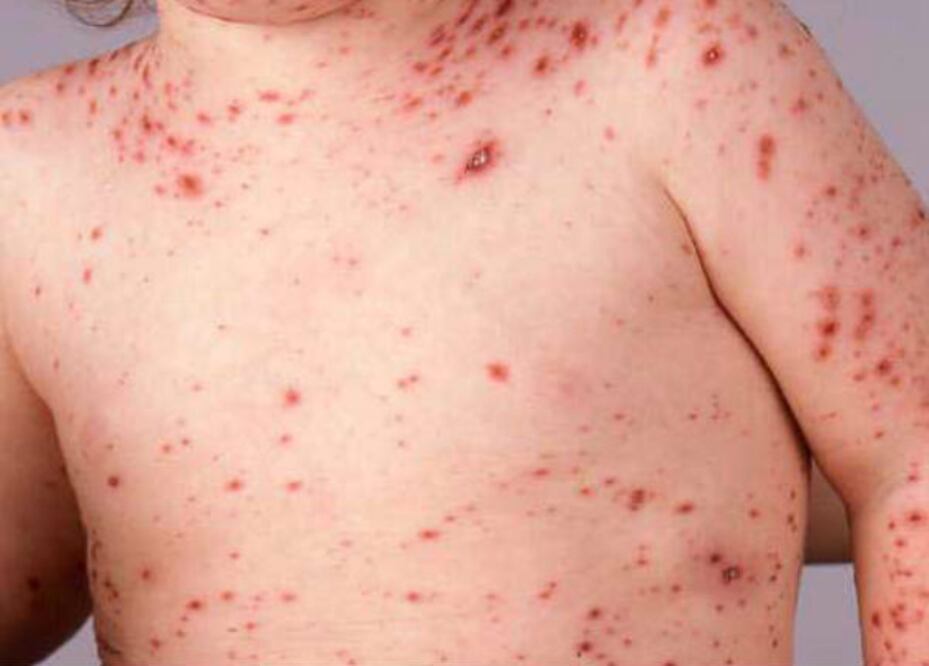 Se presenta epidemia de varicela