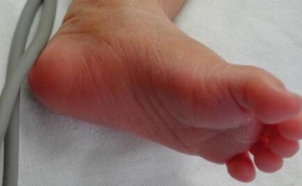 Documentan la primera muerte por sobredosis de marihuana en bebé