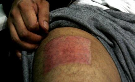 La UNAM crea un hidrogel sin fármacos para la cicatrización