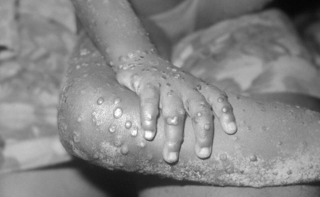 Estos son los países donde hasta ahora se han reportado casos de viruela del mono