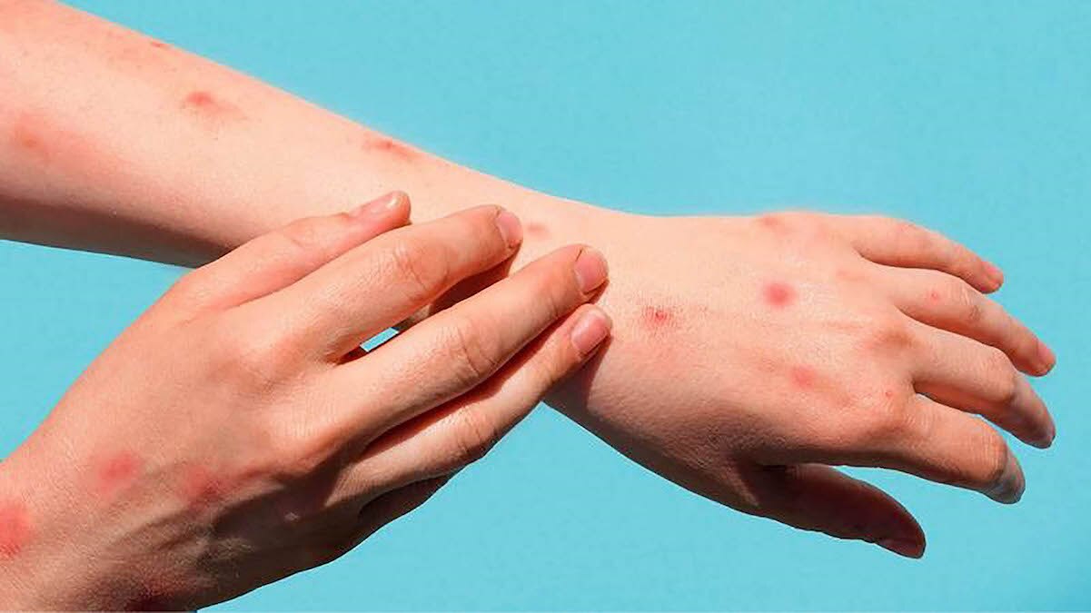 Querétaro se mantiene sin casos de viruela símica