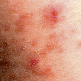 Landa de M. registra casos de dermatitis