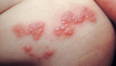 El estrés puede detonar “culebrilla” en la piel