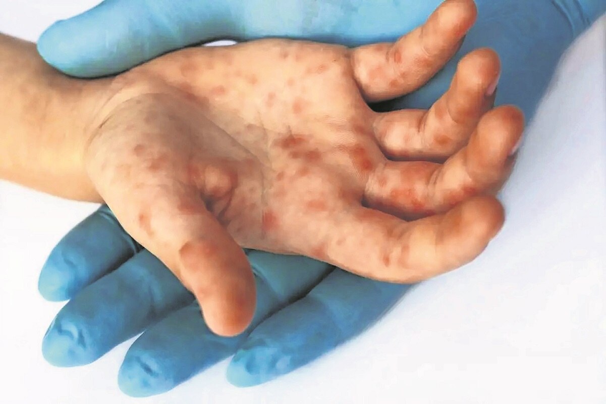 Secretaría de Salud lanza aviso epidemiológico por viruela del mono en Querétaro