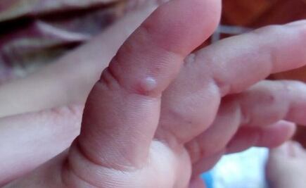 Van 117 casos de coxsackie; no reportan aumento