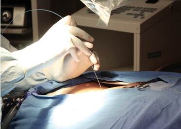 Nueva técnica para extraer litos