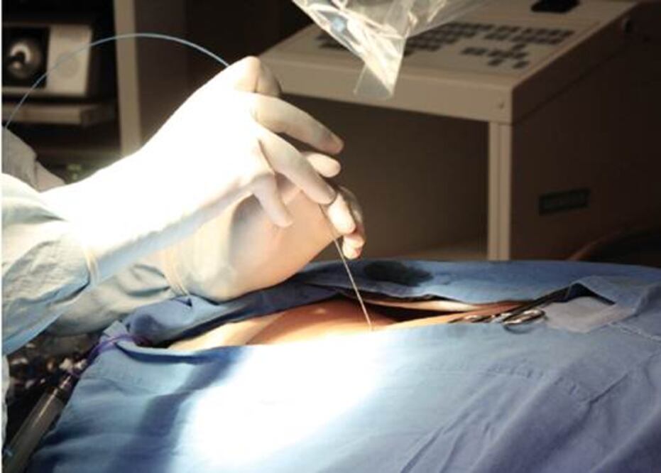 Nueva técnica para extraer litos