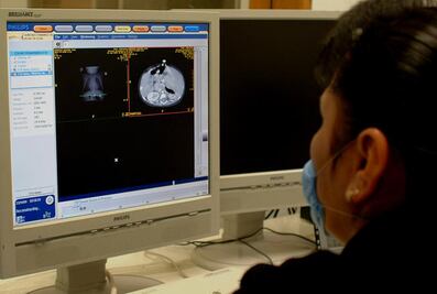 Crean nuevo sistema para detectar cáncer