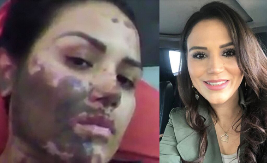 Para robarle sus pertenencias, los ladrones agredieron con ácido a una mujer