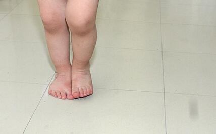 Pie plano, defecto de la niñez 