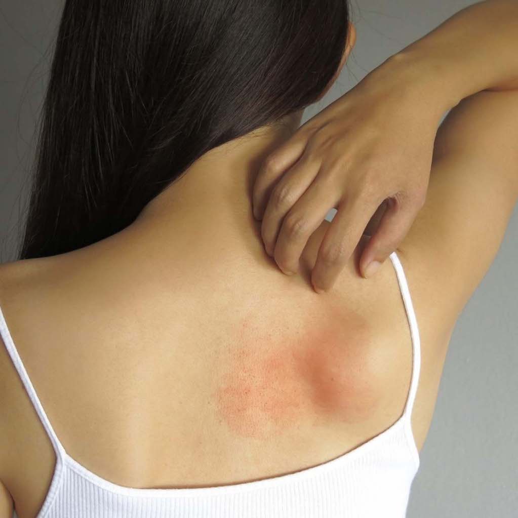 Piden atender la dermatitis atópica