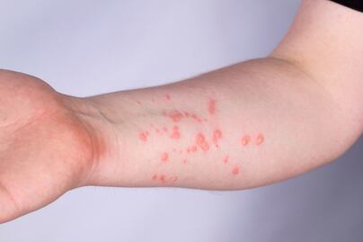 Querétaro suma tres casos de viruela del mono; dos en la capital y uno en Corregidora