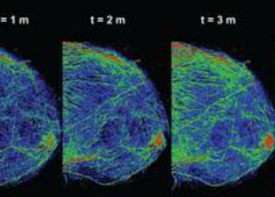 Diseñan técnicas novedosas en mamografía digital