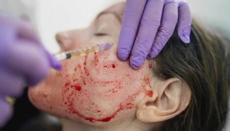 Mujeres podrían haber contraído VIH tras realizarse “facial vampiro”